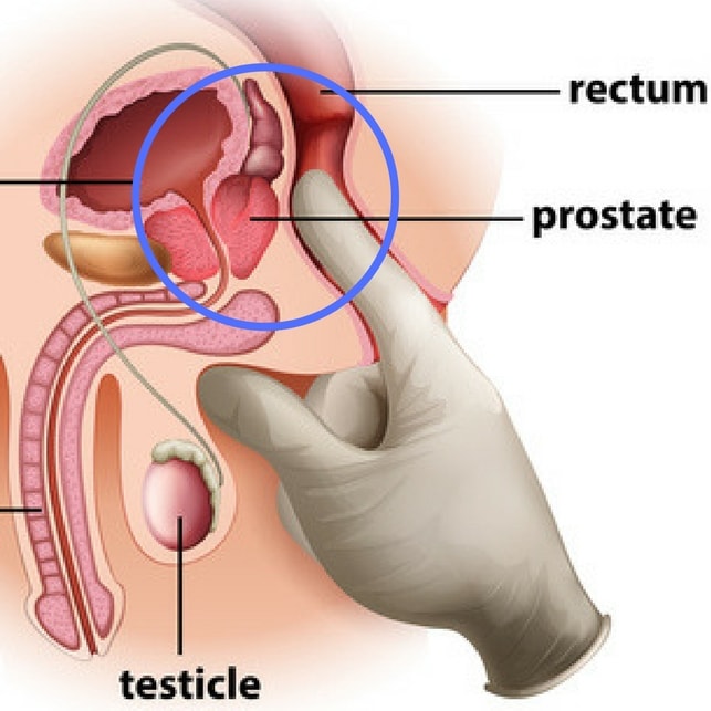 le donne hanno la prostata arsură prostatei