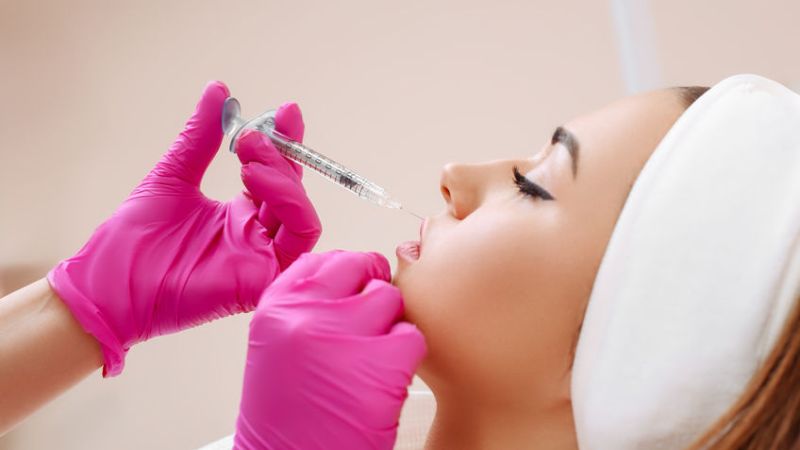 Filler labbra Filler labbra